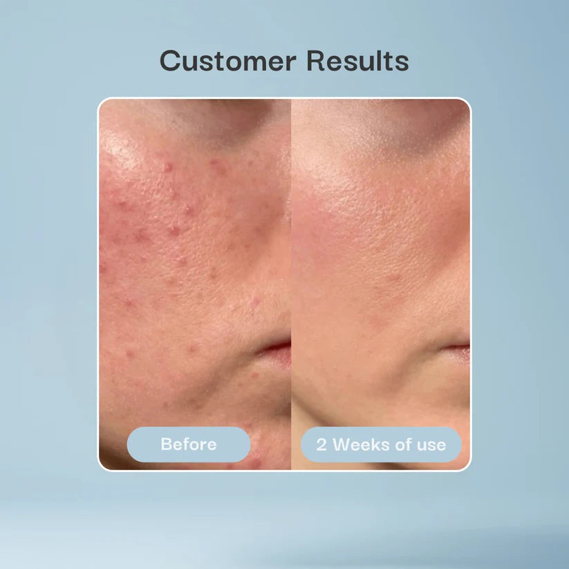 Hydrocolloid Patch Bandages for Wound & Acne Care