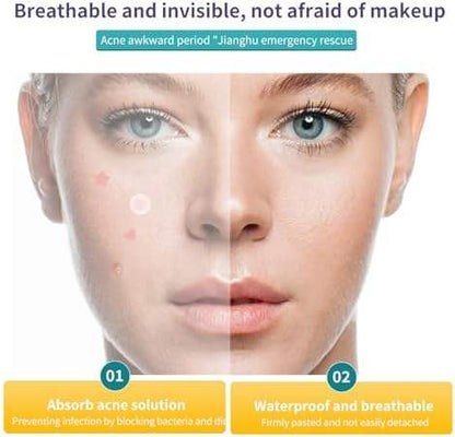 Medical Grade Acne Pimple Patch